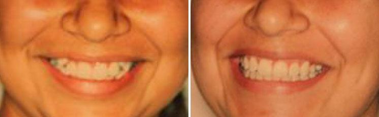 affrodable porcelain crowns